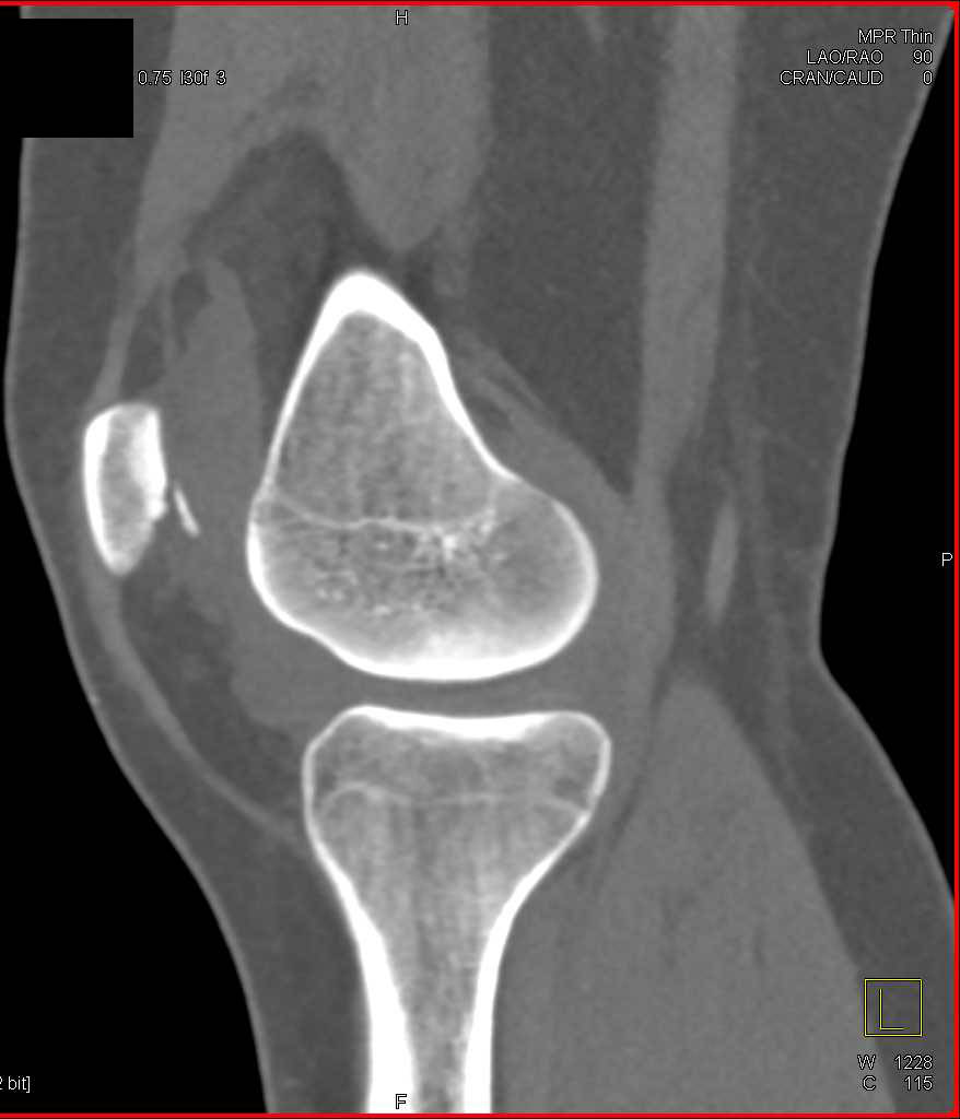 Patella Fracture with hematoma - CTisus CT Scan