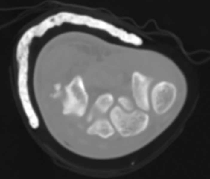 Wrist trauma with Multiple Fractures - CTisus CT Scan