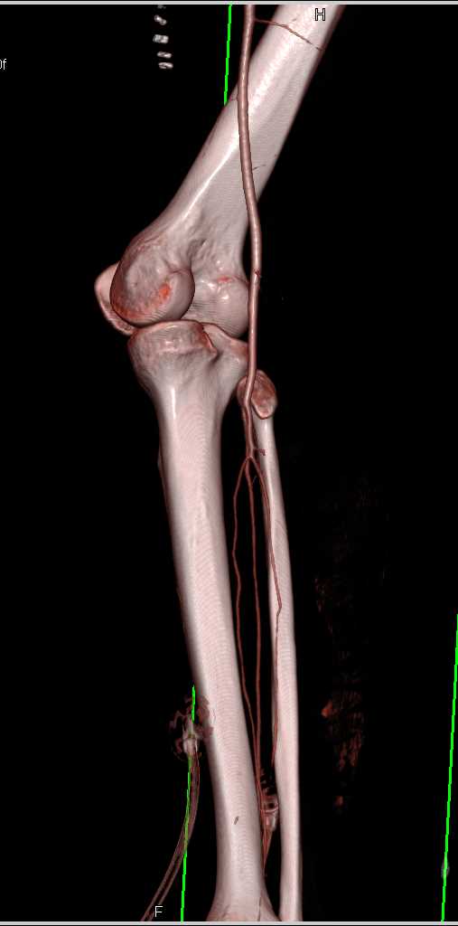 GSW Without Vascular Injury - CTisus CT Scan