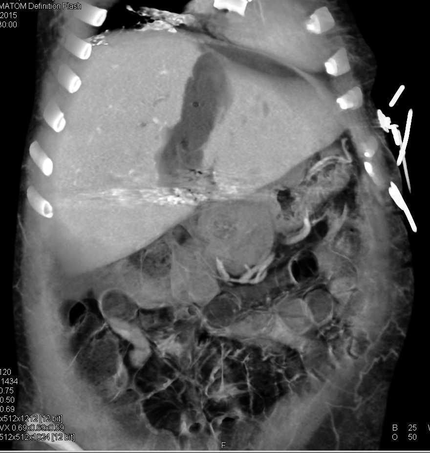 Liver Laceration Following GSW - CTisus CT Scan