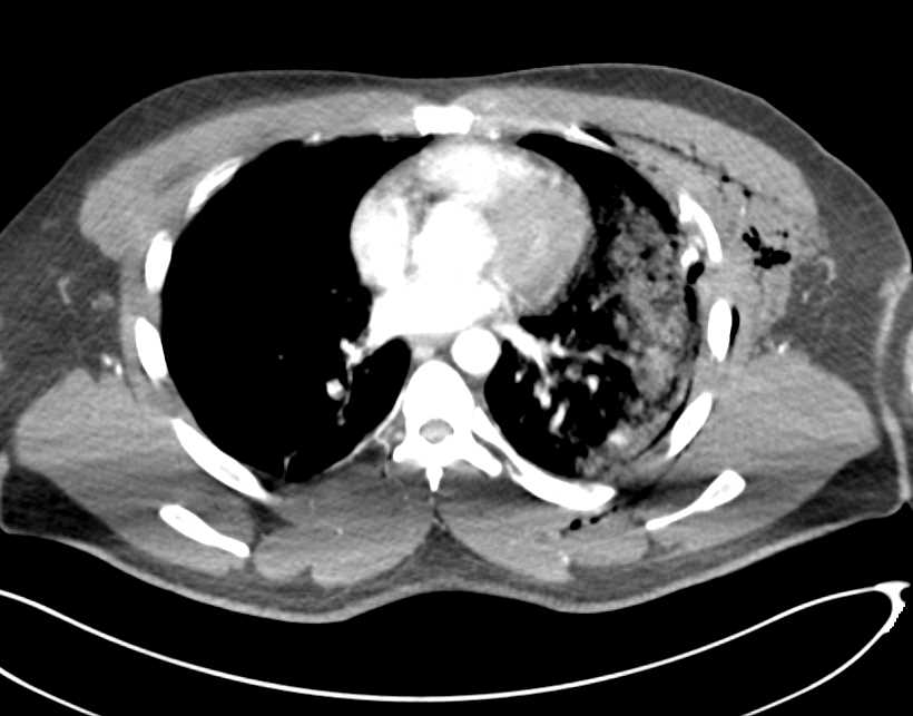 Trauma with Pulmonary Contusion and Rib Fractures - CTisus CT Scan