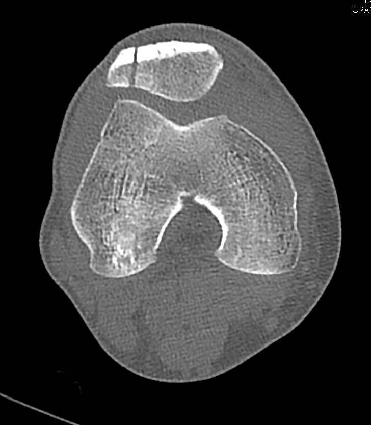 Patellar Fracture - CTisus CT Scan