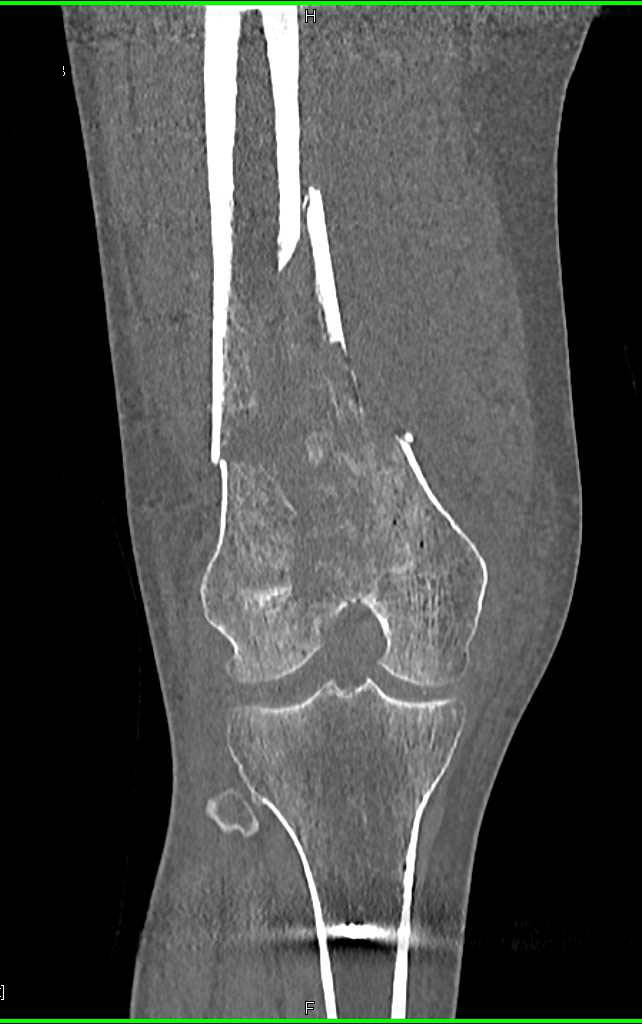 Fracture of the Distal Femur - CTisus CT Scan