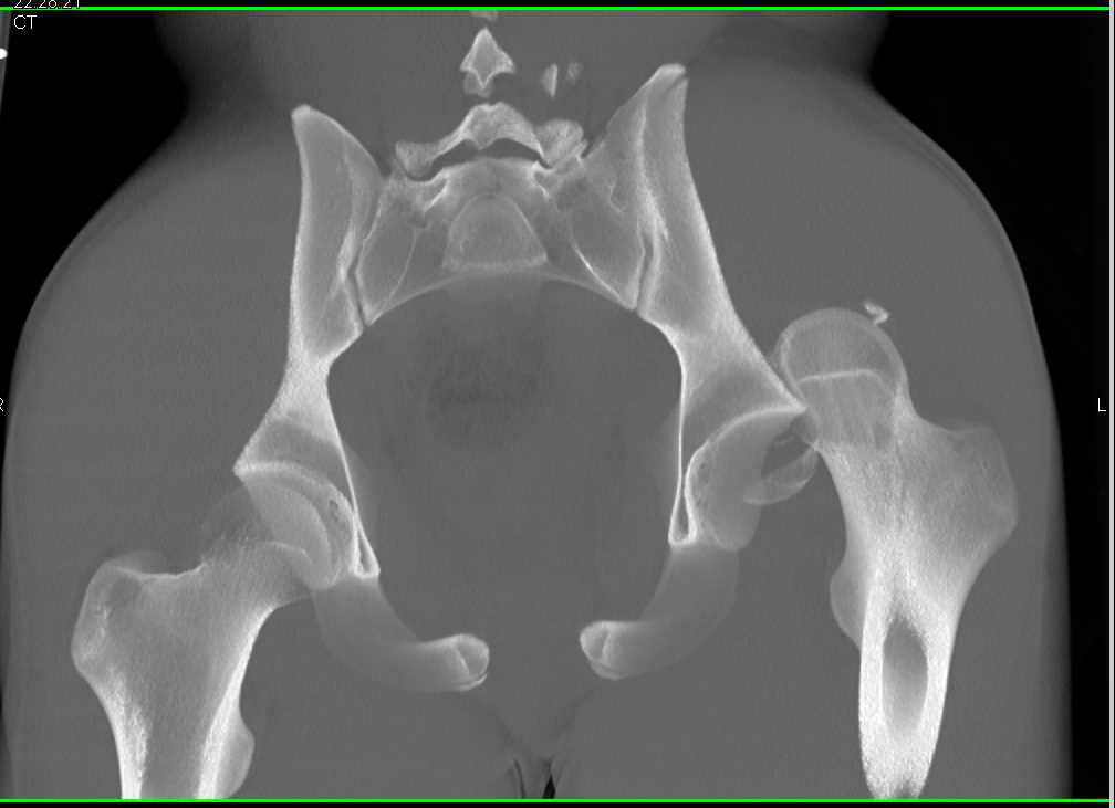 Left Hip Fracture with Dislocation with 3D Mapping - CTisus CT Scan
