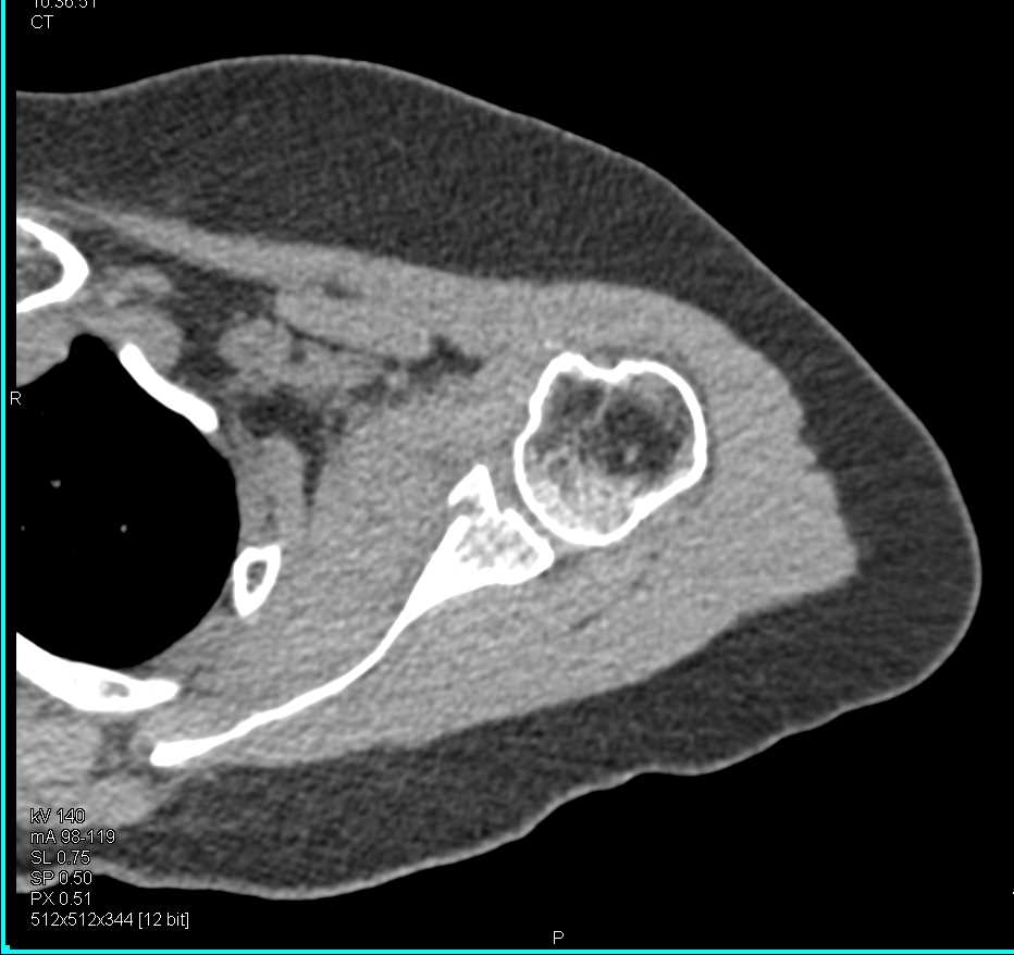Glenoid Fracture s/p Dislocation - CTisus CT Scan