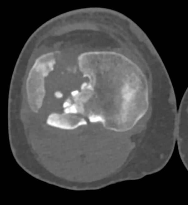 Tibial Plateau Fracture - CTisus CT Scan
