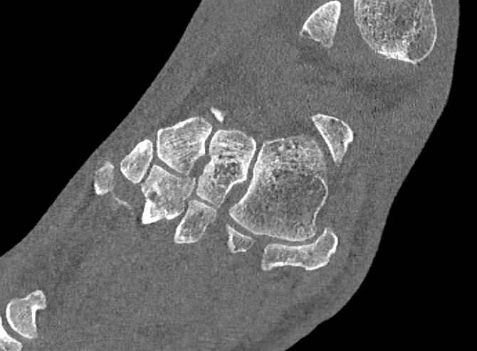 Lisfranc Fracture Dislocation - CTisus CT Scan