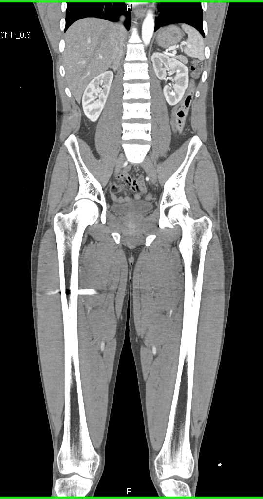GSW Thigh Without Vascular Injury with Automated Bone Removal and 3D Mapping - CTisus CT Scan