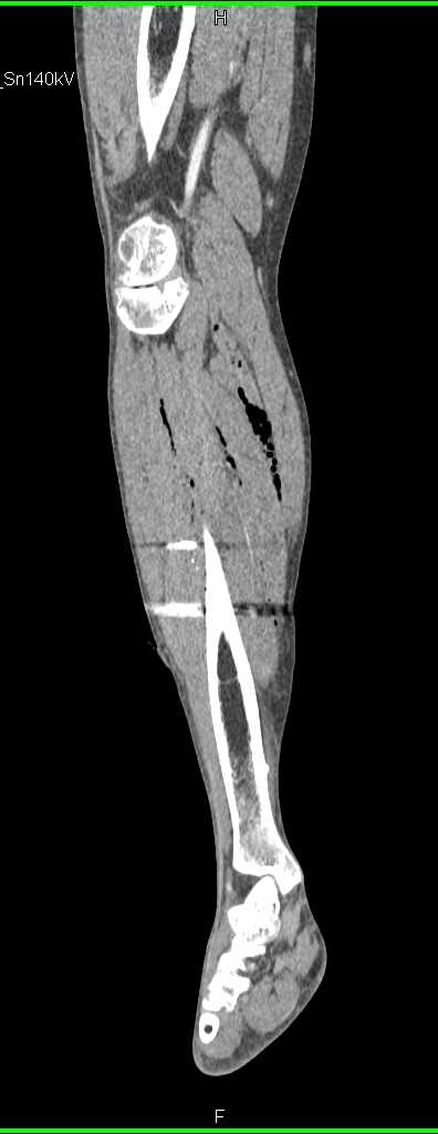 GSW Calf with Vascular Injury - CTisus CT Scan