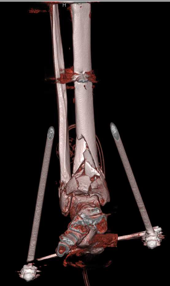 Fractures of Distal Tibia and Fibula in External Fixation - CTisus CT Scan