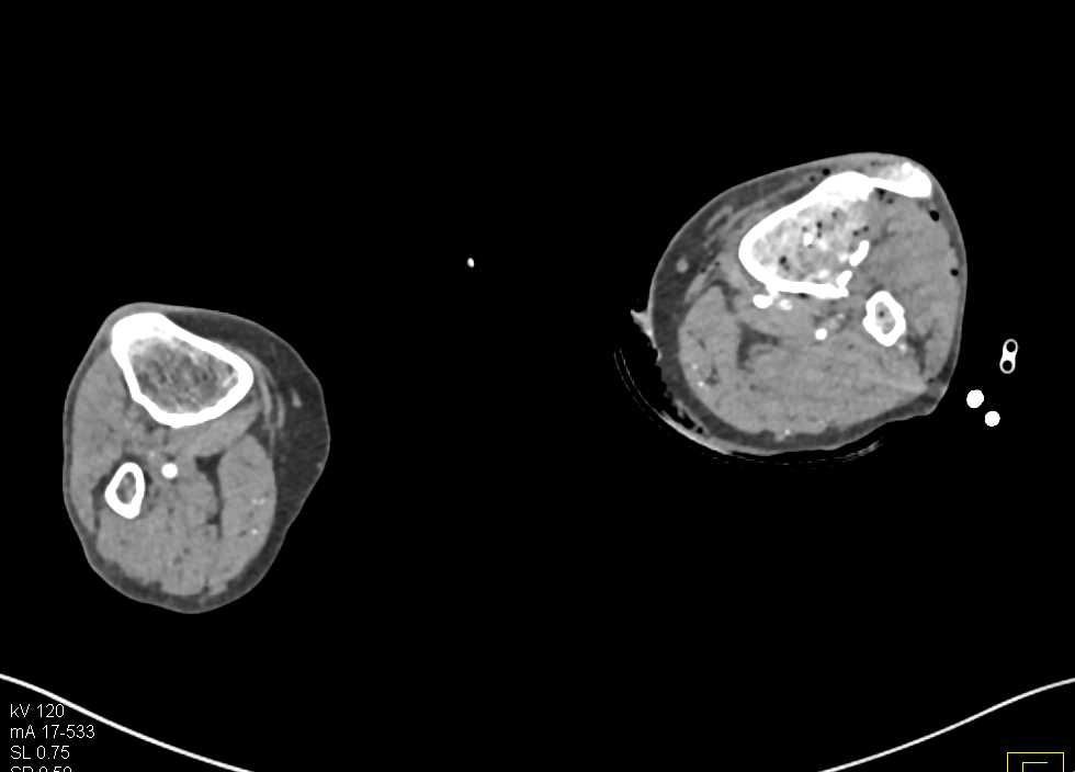 GSW with Tibia and Fibular Fractures but no Vascular Injury - CTisus CT Scan