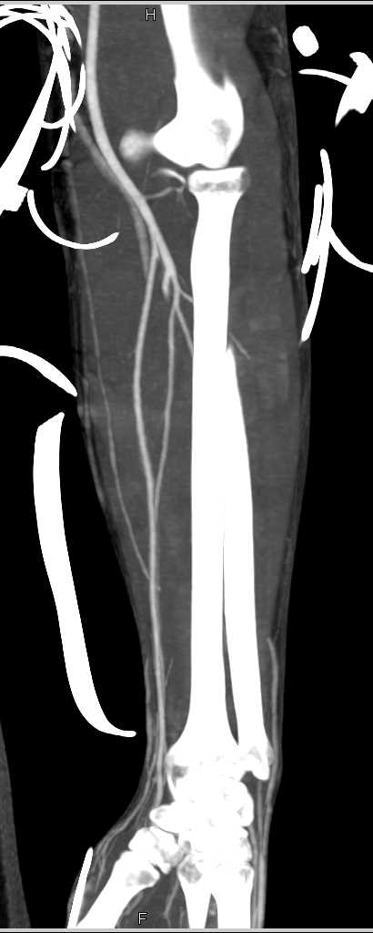 Normal CTA Forearm Post Trauma - CTisus CT Scan