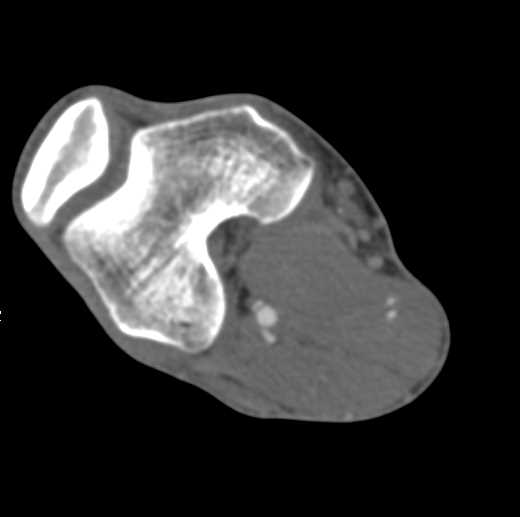 Tibia and Fibula Fractures Without Vascular Injury - CTisus CT Scan