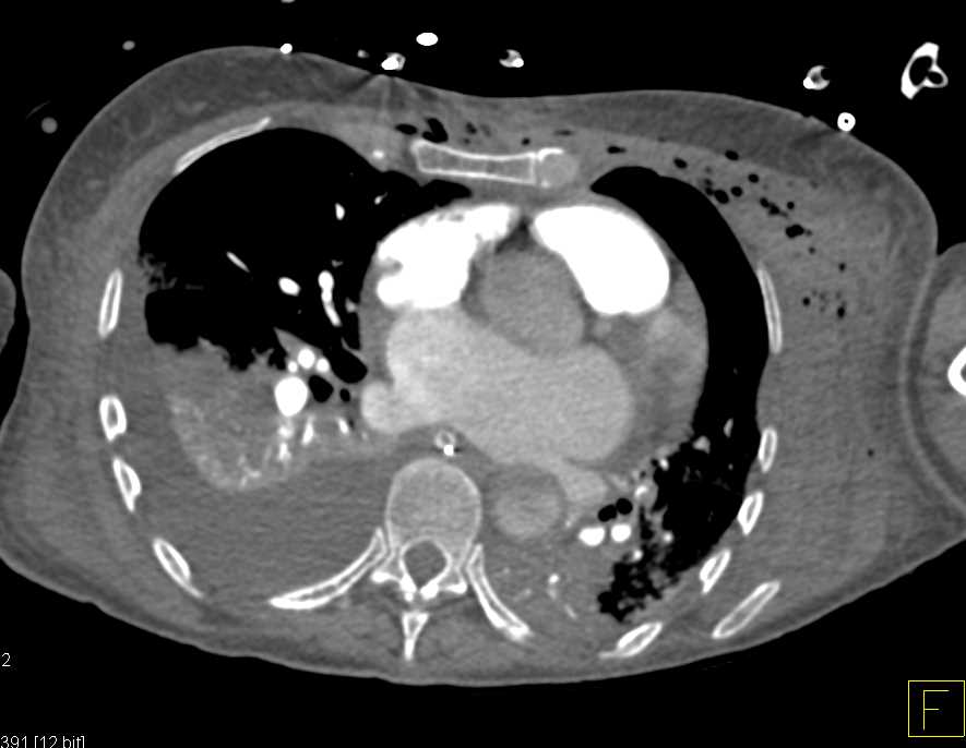 Trauma with Sternal Fracture and Air in the Chest Wall - CTisus CT Scan