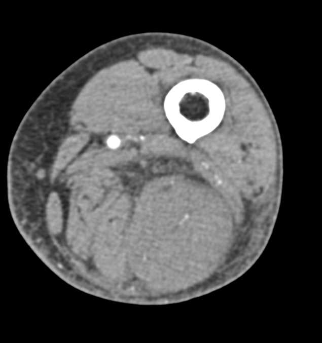 Thigh Hematoma Post Trauma with Active Bleed - CTisus CT Scan