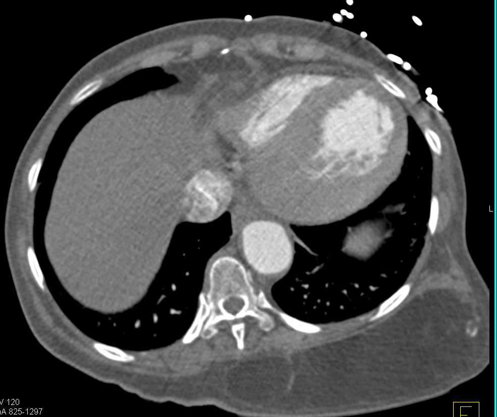 Dissection Left Subclavian Artery - CTisus CT Scan