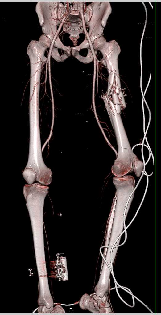 Gunshot Wound (GSW) Left Thigh with Femur Fracture and No Vascular Injury - CTisus CT Scan