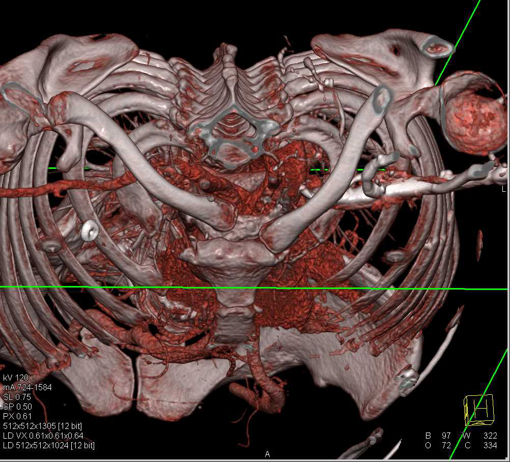 Dislocation of the Right Sternoclavicular Joint (SC Joint) Posteriorly - CTisus CT Scan