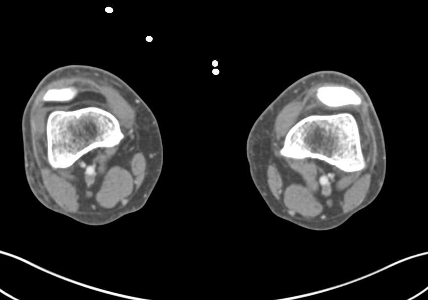 Trauma with Tibia and Fibula Fractures but no Vascular Injury - CTisus CT Scan