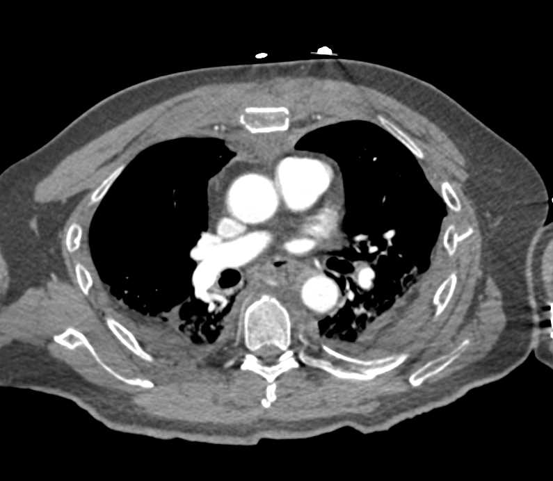 Sternal and Spine Fractures Following Motor Vehicle Accident (MVA) - CTisus CT Scan