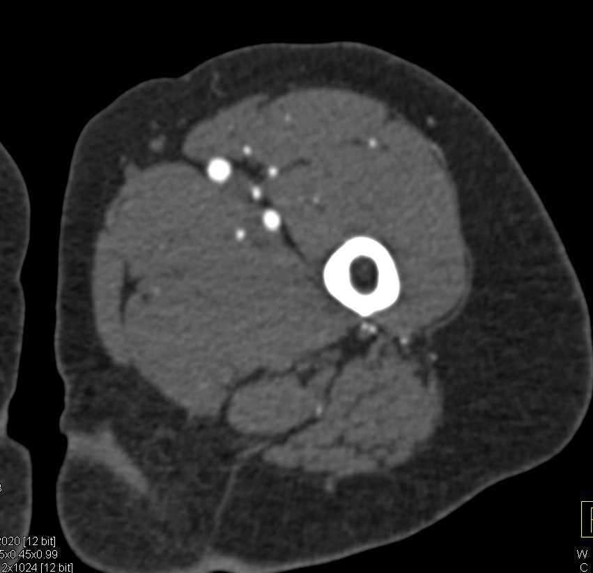 Trauma and Patellar Fracture but No Evidence of Vascular Injury - CTisus CT Scan