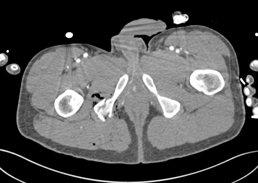 Gunshot Wound (GSW) with Fractures but Patent Vascular Map - CTisus CT Scan
