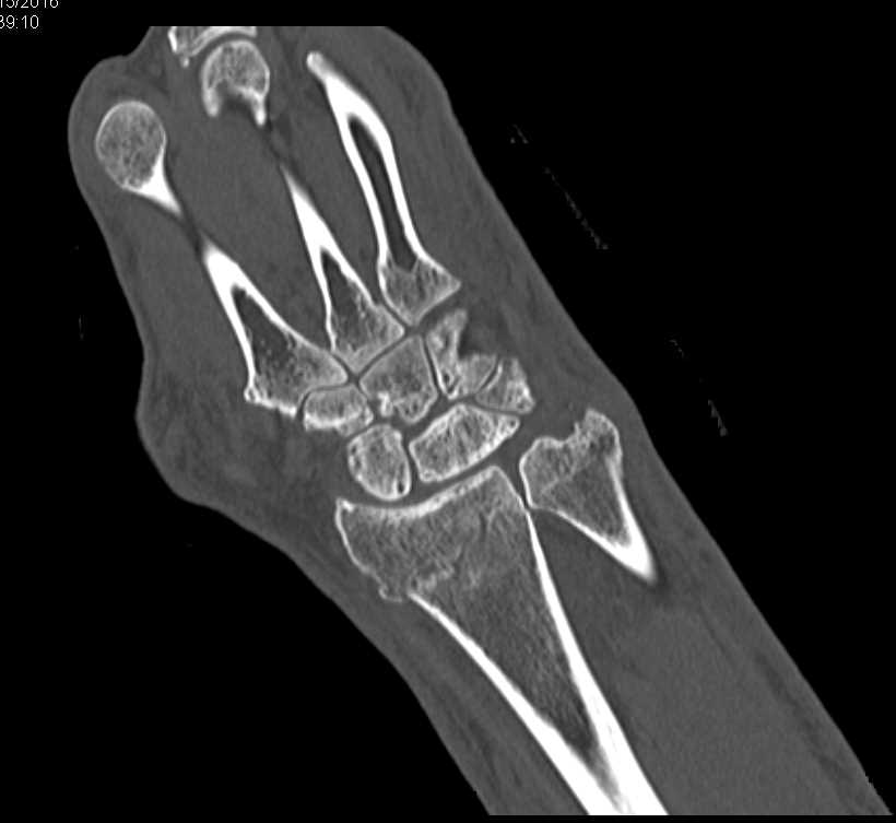 Impacted Fracture Distal Radius and Ulna - CTisus CT Scan