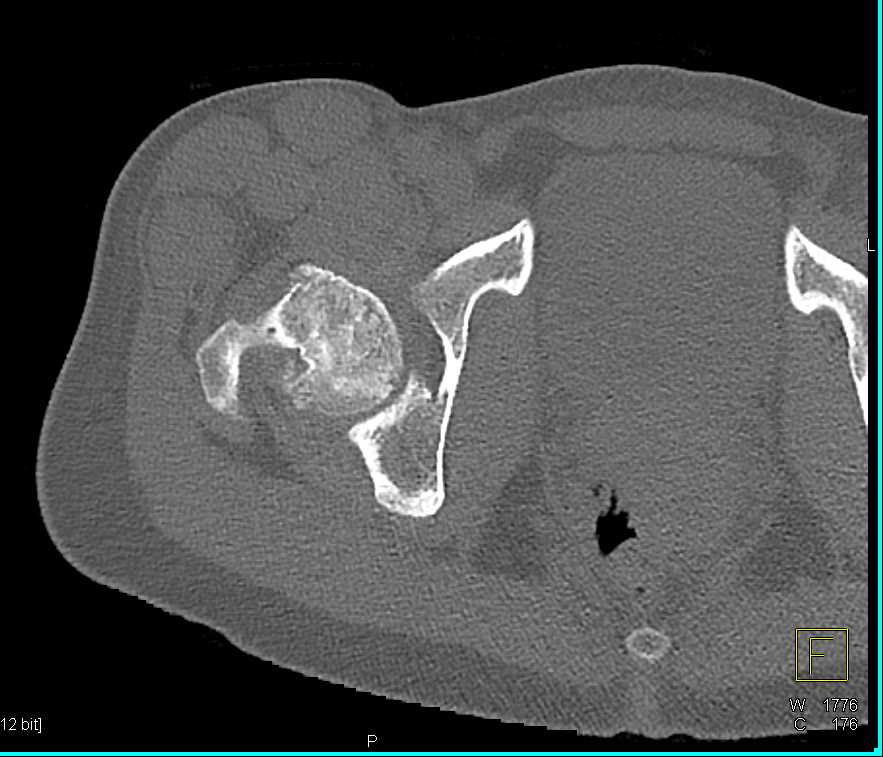 Impacted Fracture Neck of Femur - CTisus CT Scan