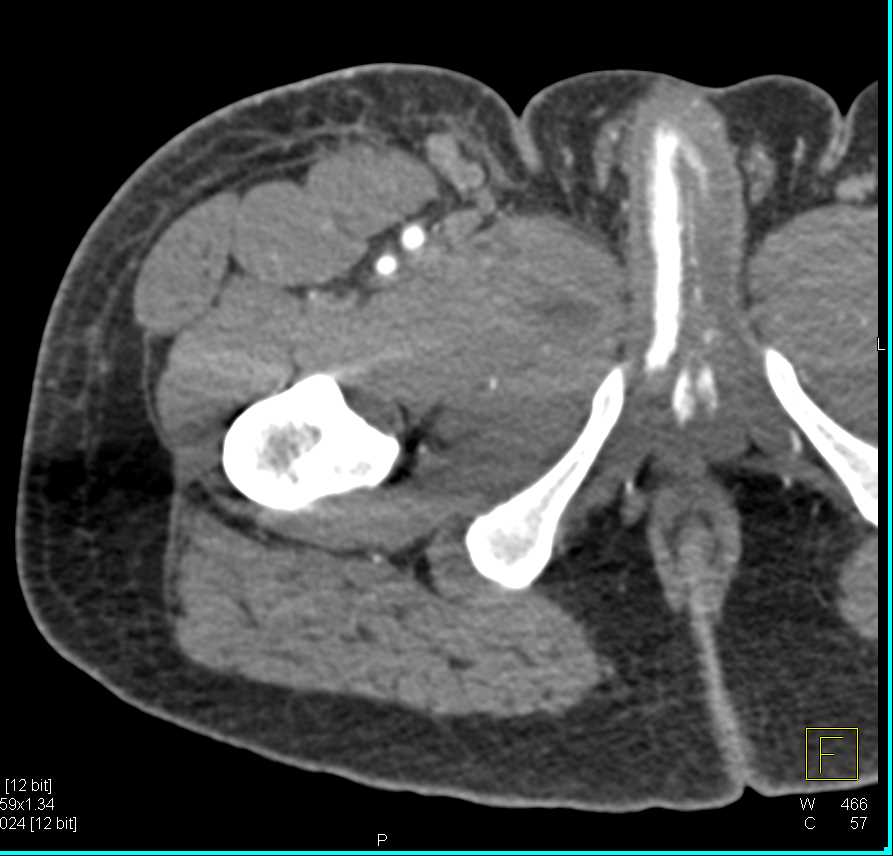 Gunshot Wound (GSW) Thigh Without Vascular Injury - CTisus CT Scan
