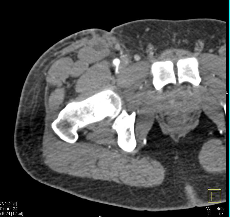Gunshot Wound (GSW) Thigh Without Vascular Injury - CTisus CT Scan