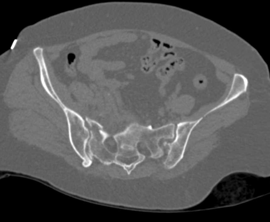 Sacral and Pelvic Fractures - CTisus CT Scan
