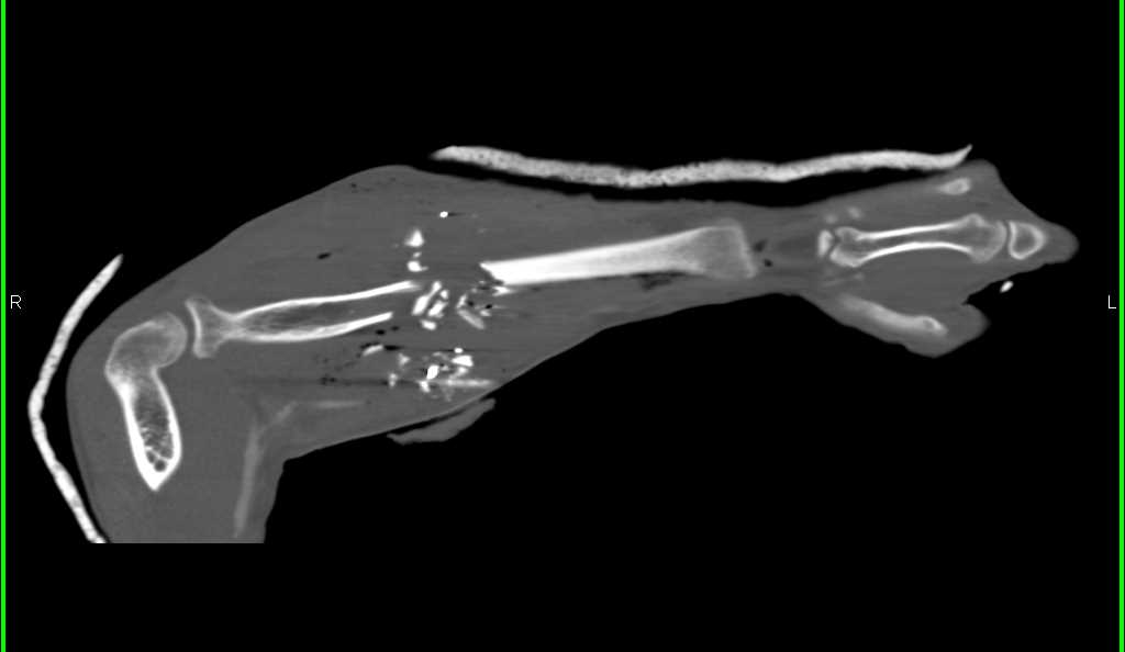 Gunshot Wound (GSW) with Comminuted Radial Fracture - CTisus CT Scan