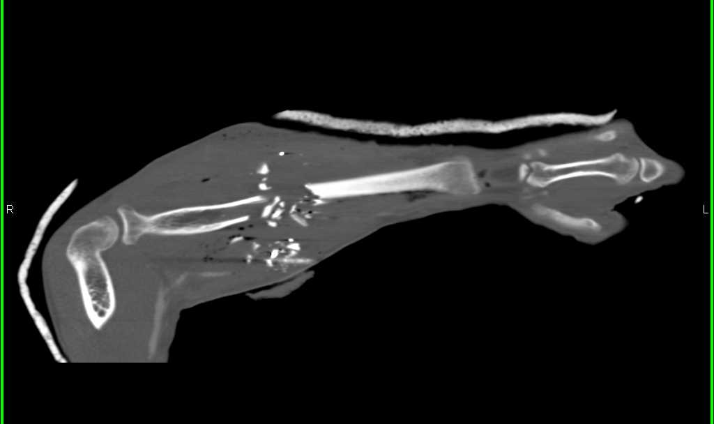 GSW with Radial Fracture and Injury to Radial Artery - CTisus CT Scan