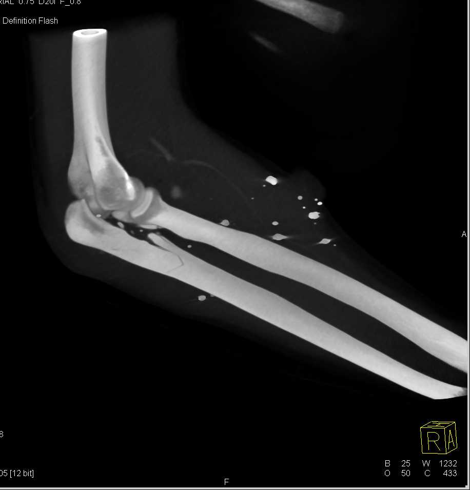 Gunshot Wound (GSW) with Ulnar Fracture and Ulnar Artery Injury - CTisus CT Scan