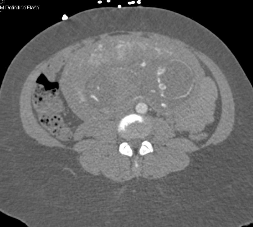 Pregnant Patient Post Trauma - CTisus CT Scan