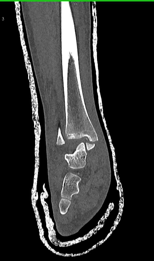 Fracture/Dislocation Ankle Mortise - CTisus CT Scan