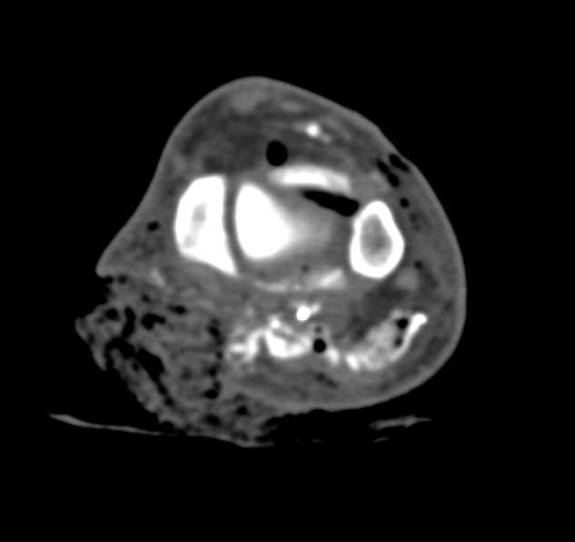 Gunshot Wound Ankle with Extensive Injury - CTisus CT Scan