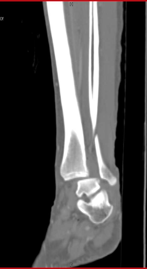 Fracture/Dislocation of the Ankle - CTisus CT Scan