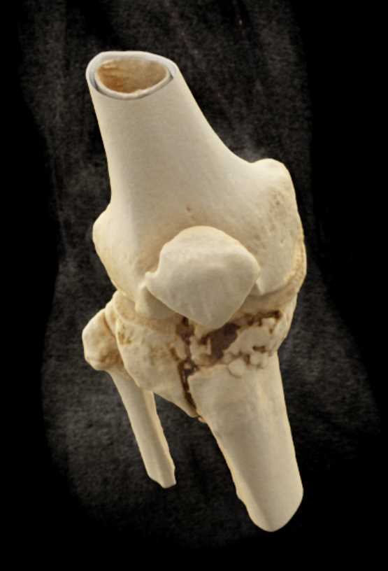 Tibial Plateau and Fibular Fractures - CTisus CT Scan