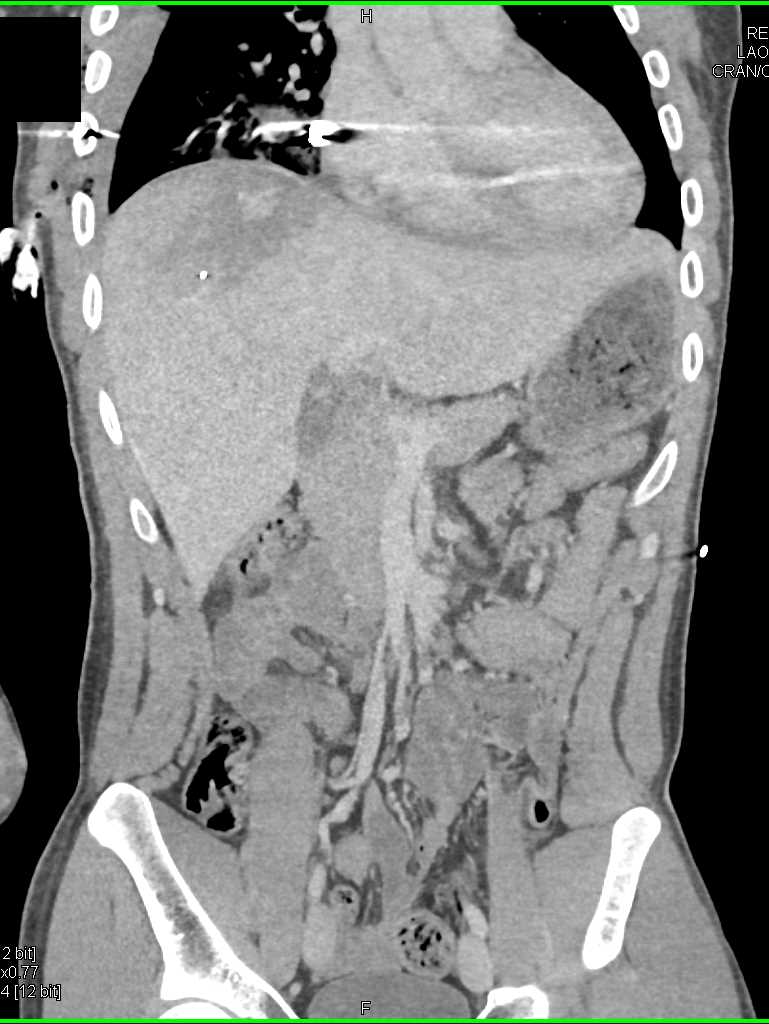 Intrahepatic Bleed s/p Trauma - CTisus CT Scan