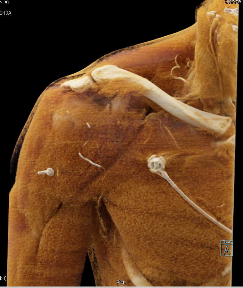 Fracture of Coracoid Process of Scapula with Cinematic Rendering - CTisus CT Scan