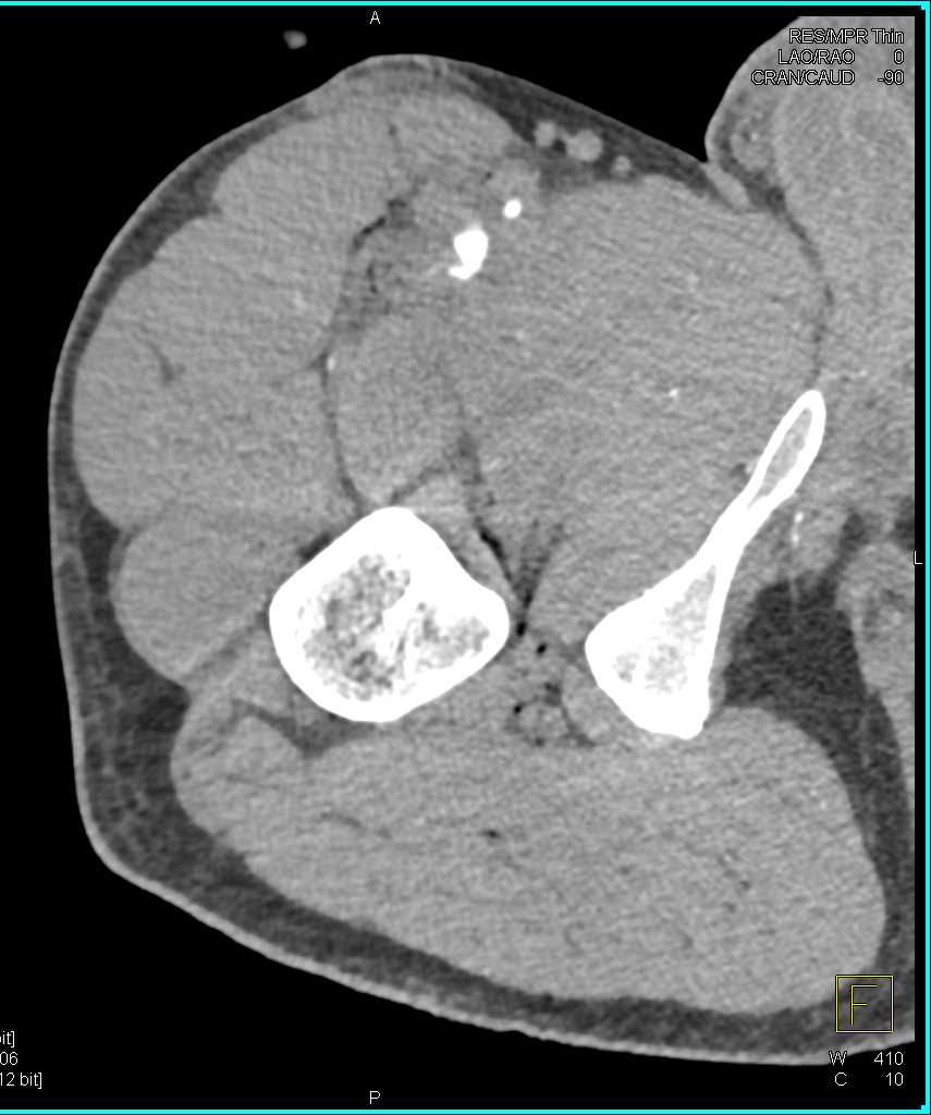 Stab Wound Thigh with Superficial Femoral Artery (SFA) Spasm - CTisus CT Scan