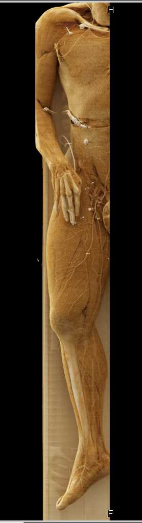 Displaced Femur Fracture Without Vascular Injury with Cinematic Rendering - CTisus CT Scan