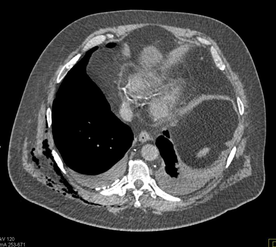 Chest Trauma with Rib Fractures - CTisus CT Scan