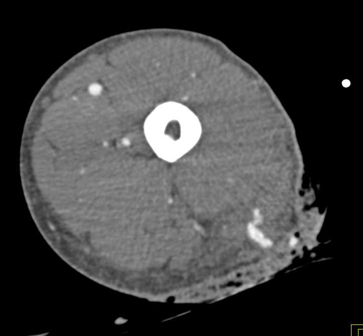 Stab Wound Thigh with Active Bleed and Muscle Injury - CTisus CT Scan