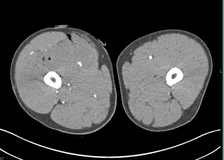 Stab Wound with Superficial Femoral Artery (SFA) Injury Right Thigh - CTisus CT Scan