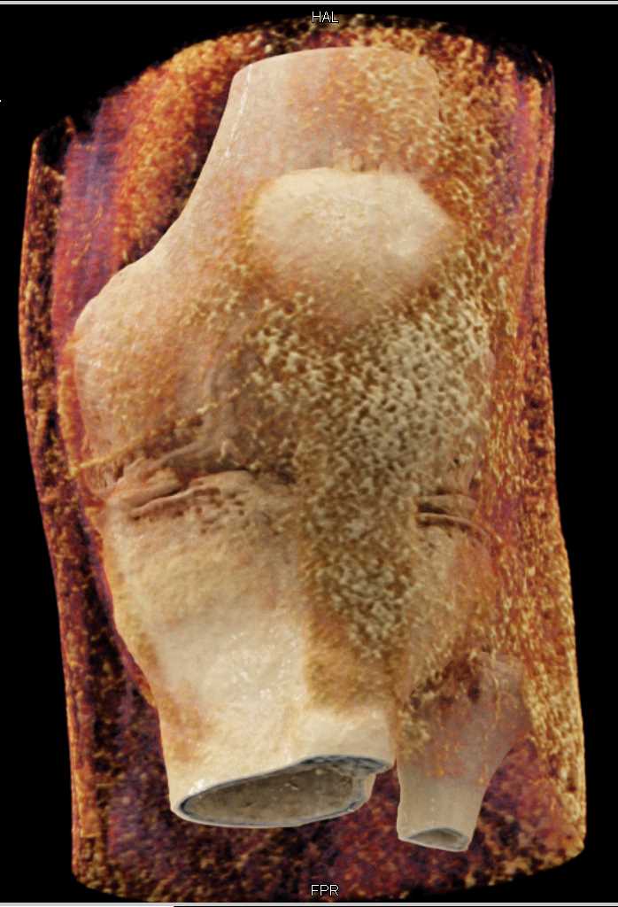 Femur Fracture with Cinematic Rendering - CTisus CT Scan