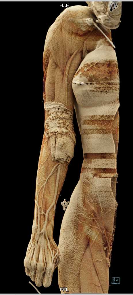 Upper Extremity Trauma Without Vascular Injury - CTisus CT Scan