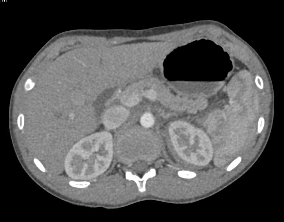 Renal Laceration Left Kidney with Peri-renal Bleed - CTisus CT Scan