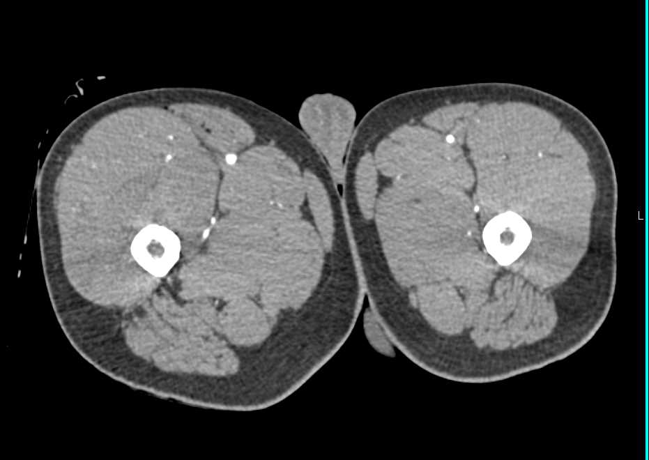Gunshot Wound (GSW) Right Thigh with Superficial Femoral Artery (SFA) Injury and Active Bleed - CTisus CT Scan